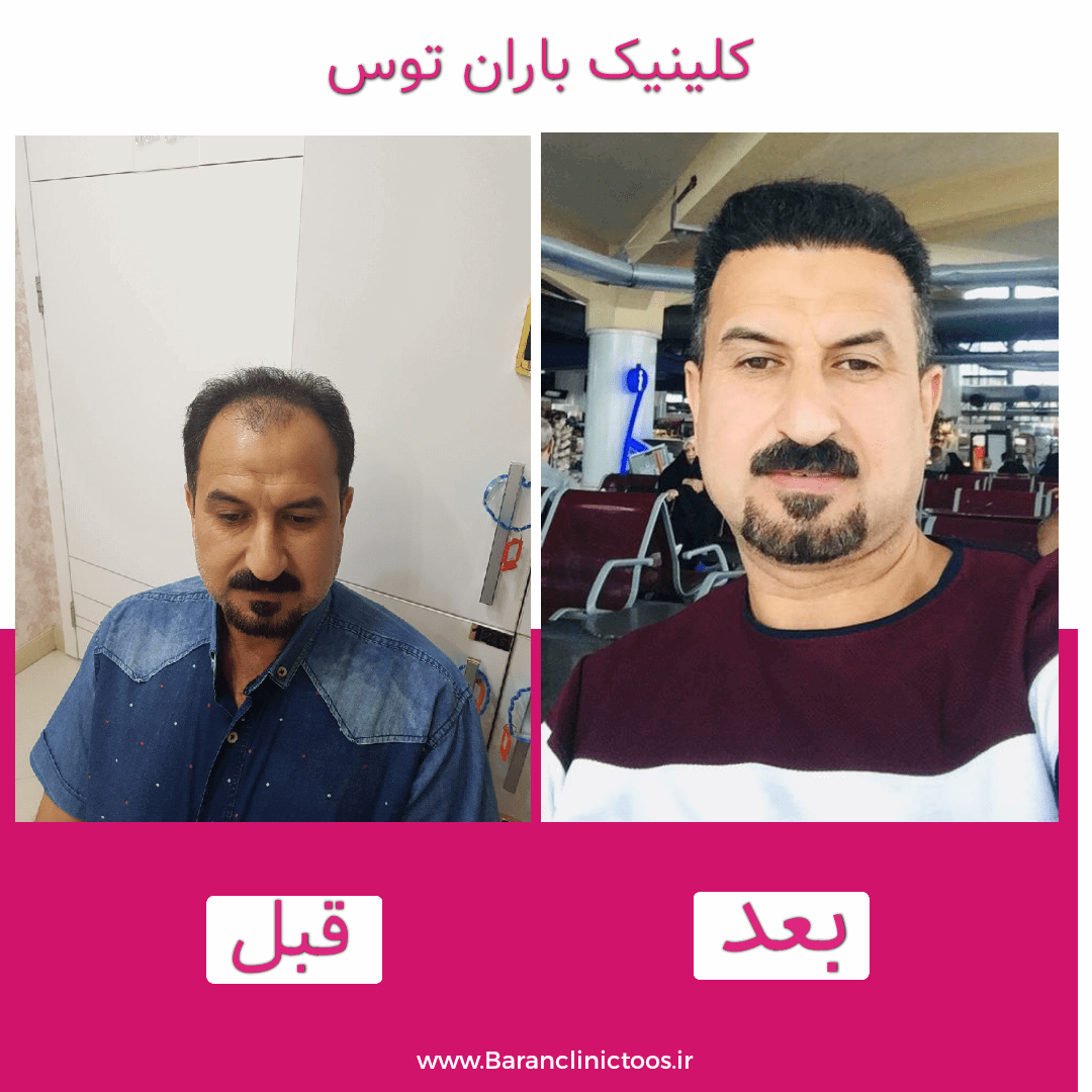 قبل و بعد کاشت مو